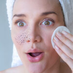 #Blackheads #whiteheads #skincaretips #beautytips #skincare #selfcare, pimples, acne, men acne, balckheads, blackheads extraction, blackheads removal