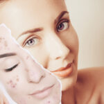 Acne skin care routine, acne skin care products,