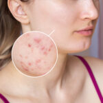 Acne skin care