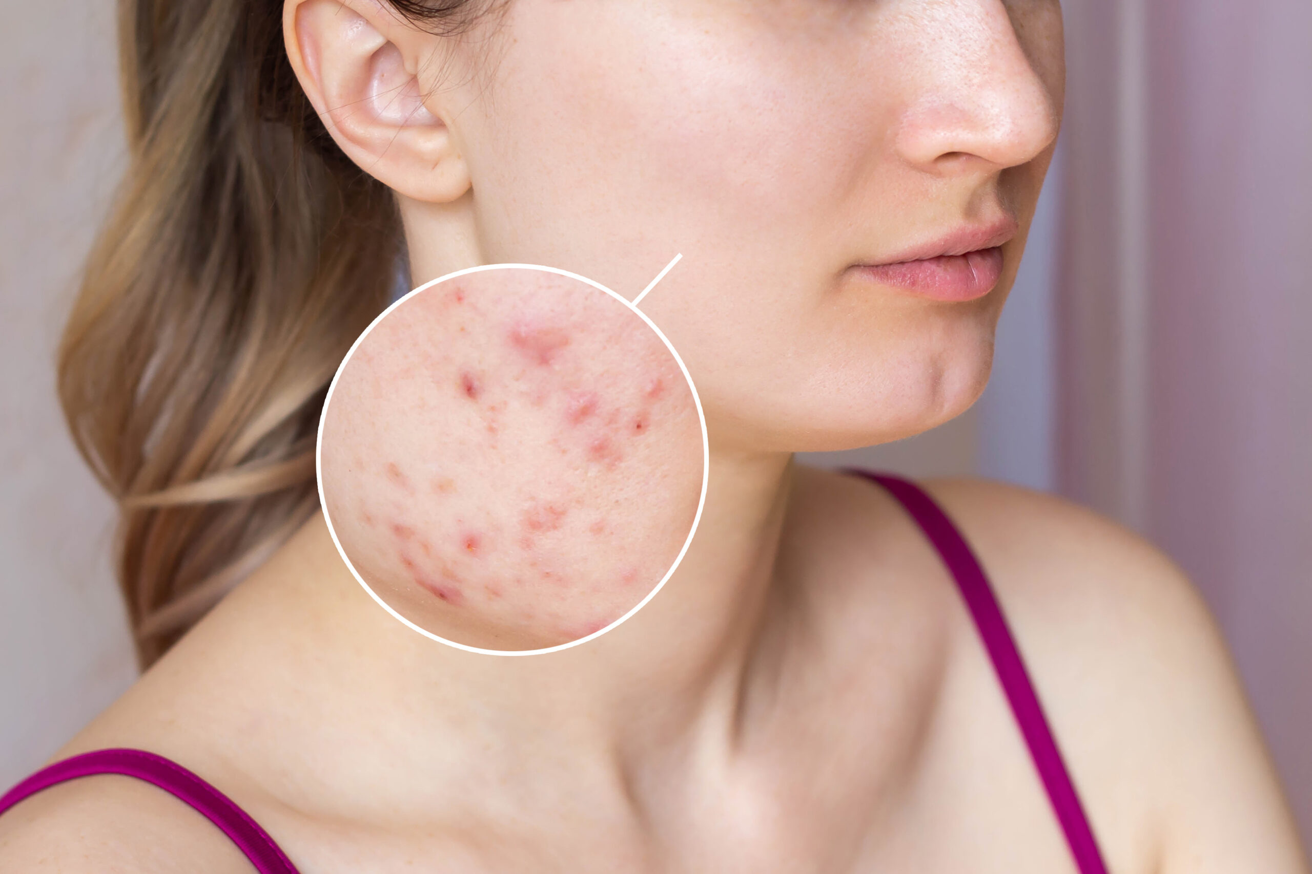How to Get Rid of Acne Scars Fast?