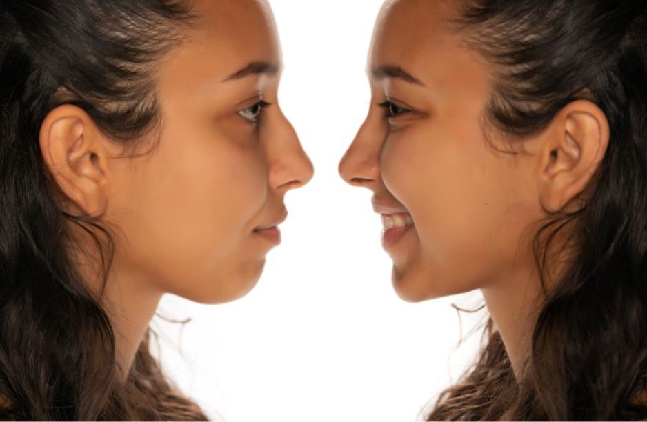 Rhinoplasty: Getting the Perfect Nose For Your Face