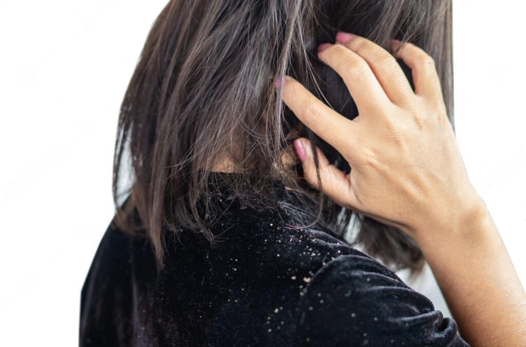 home remedies for dandruff