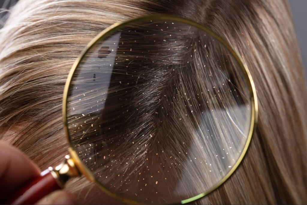 how to control dandruff and itchy scalp